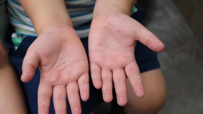 Child's open palms showing small red rash spots on the skin between fingers and palms